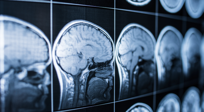 Water-Related Brain Injury - Zayouna Law Firm